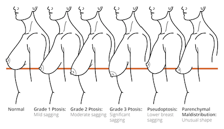 borderline breast lift