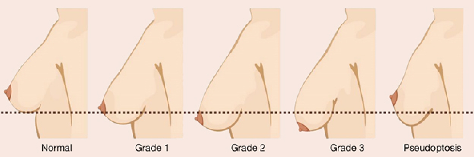 breast lift and implants