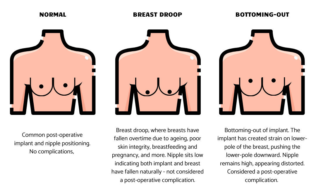 breast implant bottoming out