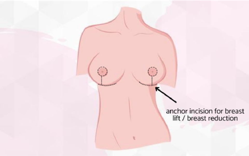 mummy makeover brisbane