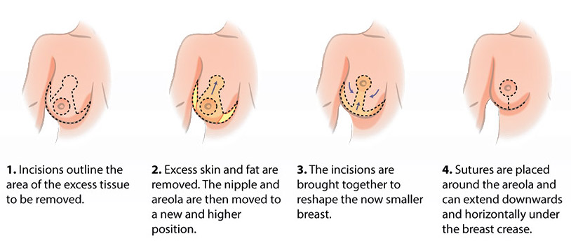 breast reduction surgeon brisbane