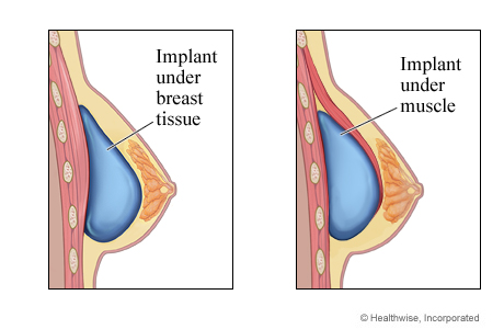 Breast Implants in Brisbane