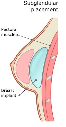 over the muscle breast augmentation