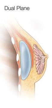 dual plane breast augmentation
