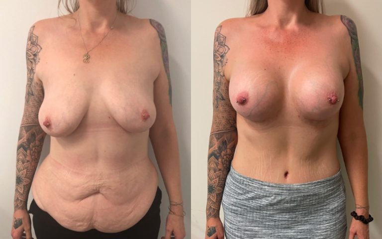 Breast augmentation and abdominoplasty, commbined plastic surgery results (breast & body), before and after 1, BPCS Brisbane