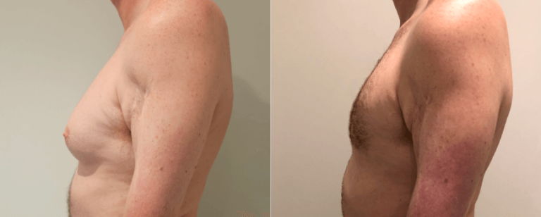 Male patient before and after surgery for Mastopexy 1, Brisbane Plastic Surgery