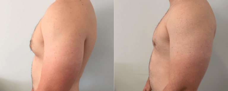 Gynaecomastia surgery (male breast reduction surgery), patient before and after 2-4, side view, BPCS
