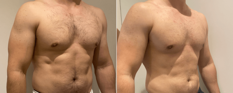 Male breast reduction results 2, BPCS, Dr Richardson