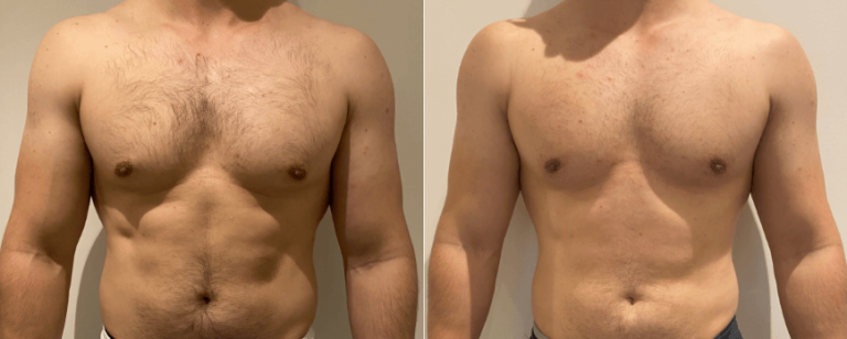 Gynaecomastia surgery, before and after 3, Dr Richardson, BPCS Brisbane