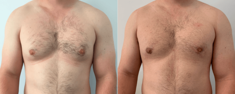 Gynaecomastia surgery in Brisbane, patient before and after 5, front view, BPCS