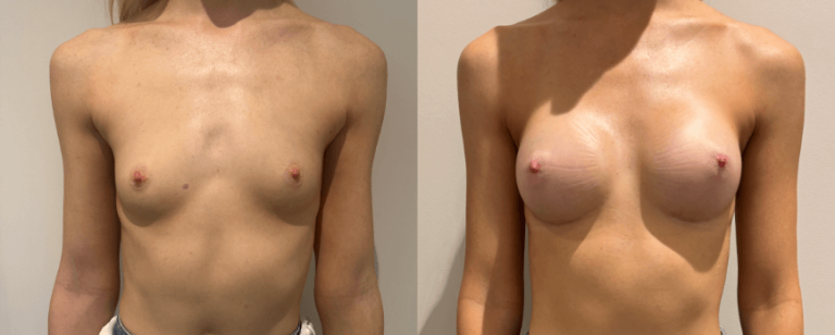 Breast Augmentation (breast implants), before and after 1, front view, BPCS Brisbane