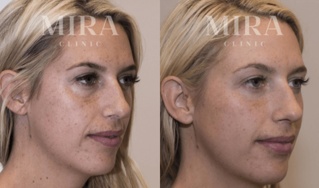 Facial rejuventaiotn before and after image 10, mira clinic