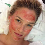 Bar prp - mira clinic - 5