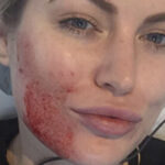 Keira prp - mira clinic - 7