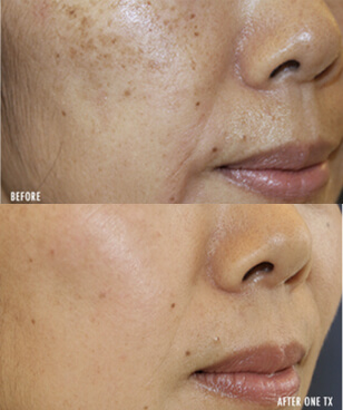 Picogenesis ba1 - mira clinic - 7