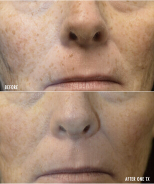 Picogenesis ba2 - mira clinic - 5