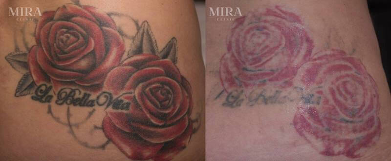 36970465 1800460310033030 2711668911325052928 o 1 - mira clinic - 3