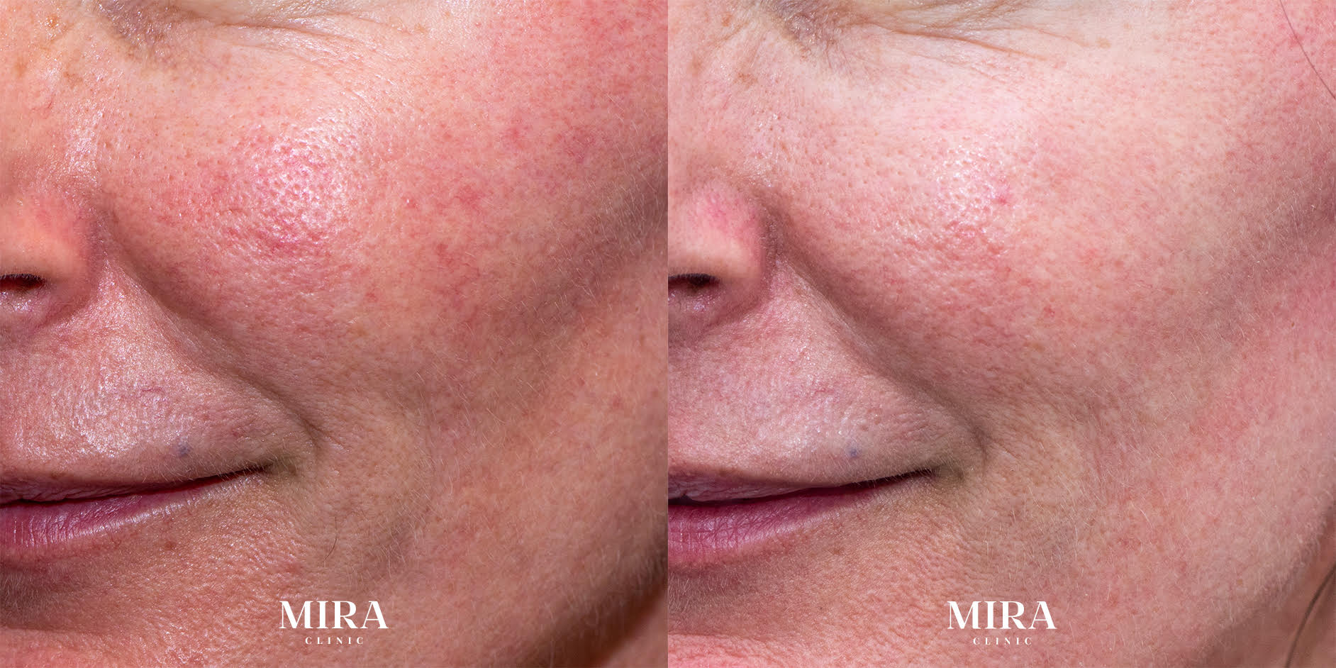 Before and after - mira clinic - 3