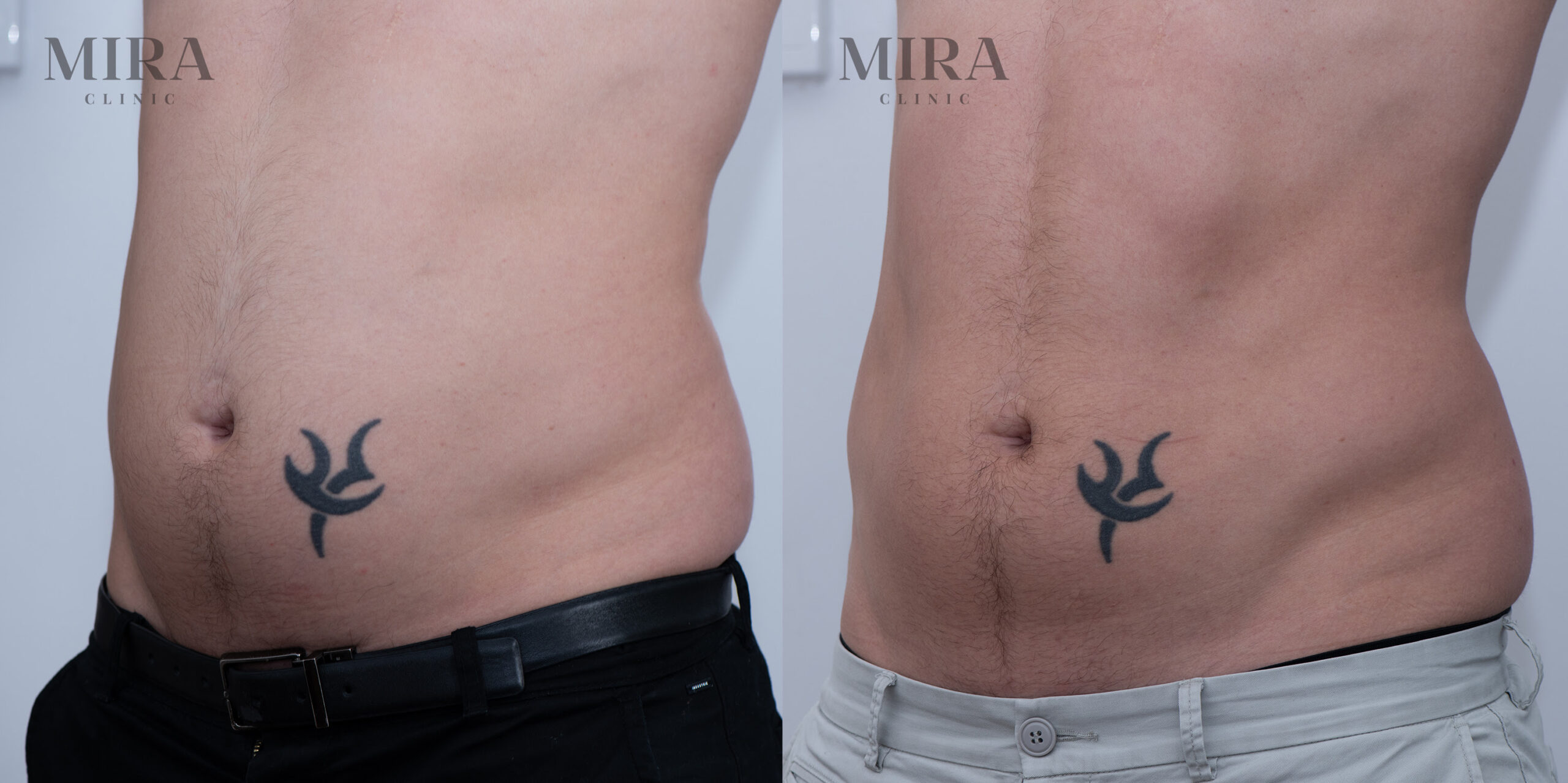 Unnamed 1 scaled - mira clinic - 13