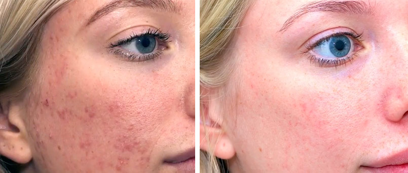 Before after hydra - mira clinic - 3