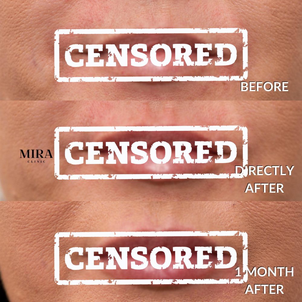 Lip fillers results 01 (censored), mira clinic