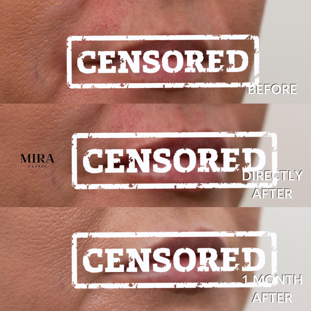 Lip fillers, before and after 03, mira clinic