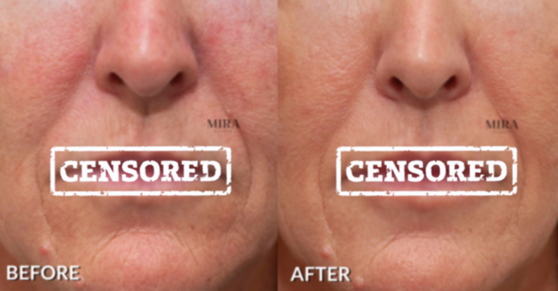 Censored image of lip fillers results 01, mira clinic