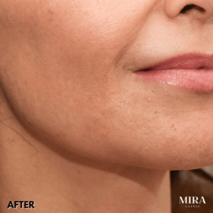 After - mira clinic - 4
