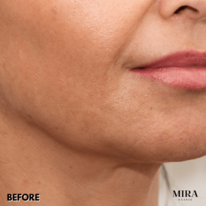 Before - mira clinic - 2