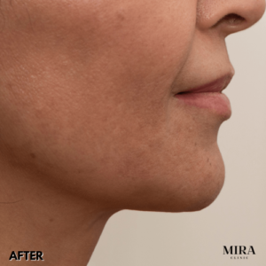 After 1 - mira clinic - 8