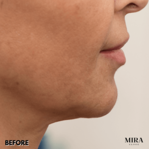 Before1 - mira clinic - 6