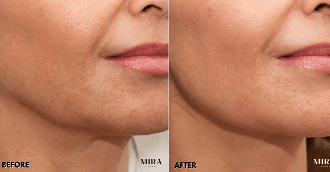 Non-surgical treatments to lift and tighten your neck and profile, before and after
