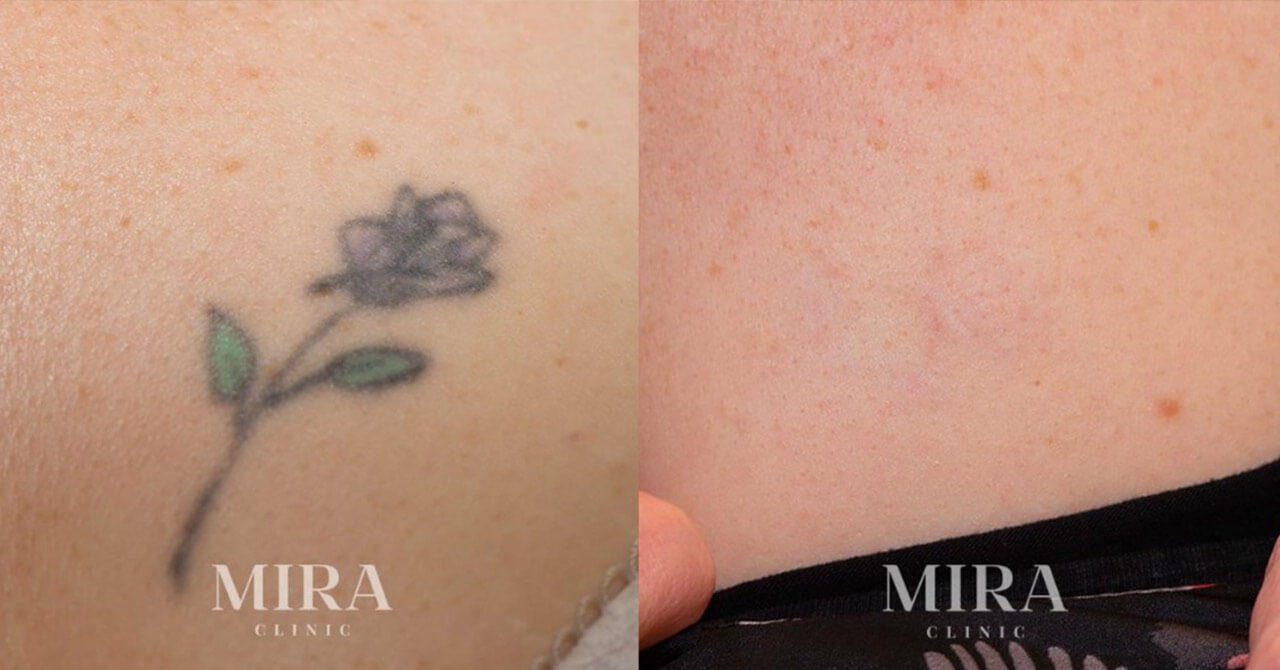 Laser tattoo removal, before and after, mira clinic