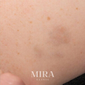 Ltr after img7 - mira clinic - 4