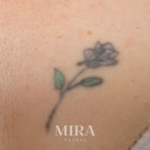 Ltr before img - mira clinic - 2