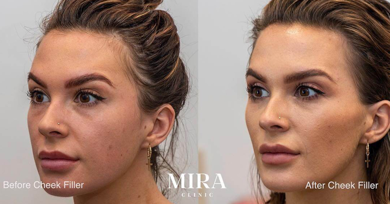 Blog img 2 - mira clinic - 69