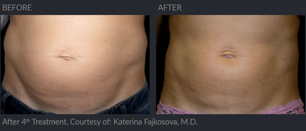 Emsculpt before and after 01, MIRA Clinic