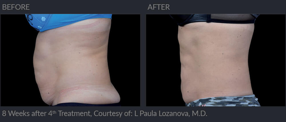 Emsculpt before and 8 weeks post-treatment 02a, MIRA Clinic