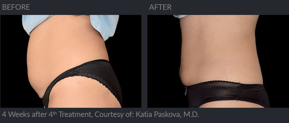 Emsculpt before and after 03a, MIRA Clinic