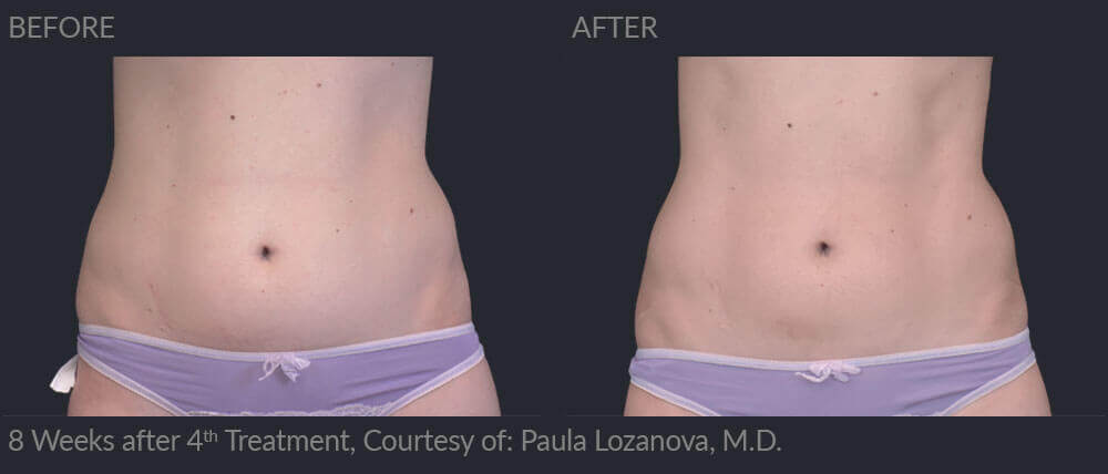 Emscupt before and after 04, MIRA Clinic