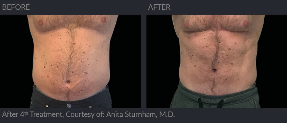 Male patient, Emsculpt before and after 4th treatment 05-1, MIRA Clinic
