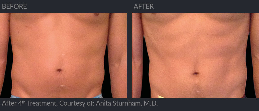 Emsculpt, before and after the 4th treatment 06a, MIRA Clinic