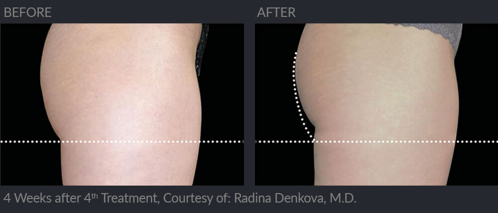 Buttock emsculpt, before and 4 weeks after 4th treatment 07, MIRA Clinic