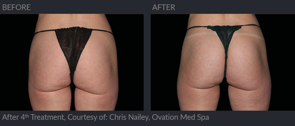 Buttock emscupth, beforre and after the 4th treatment 08a, MIRA Clinic