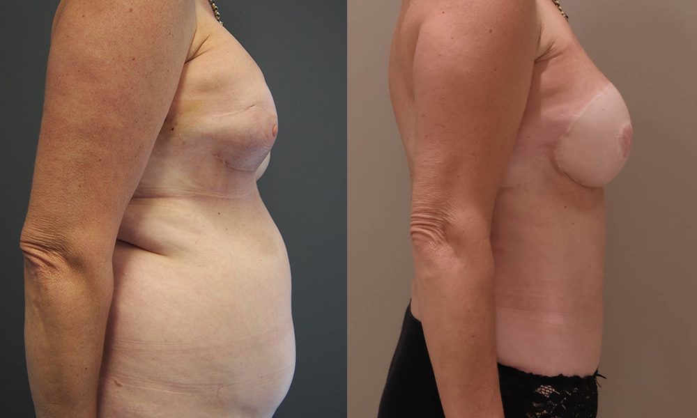 BreastReconstruction 1 Gallery DIEP Flap Breast Reconstruction - 8