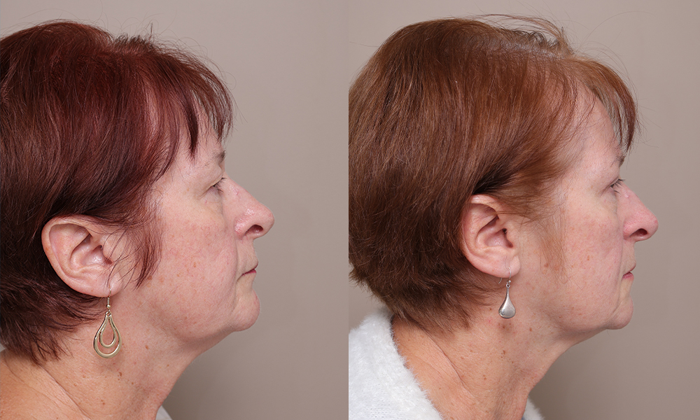 Blepharoplasty img 1 3 Gallery Blepharoplasty - 10