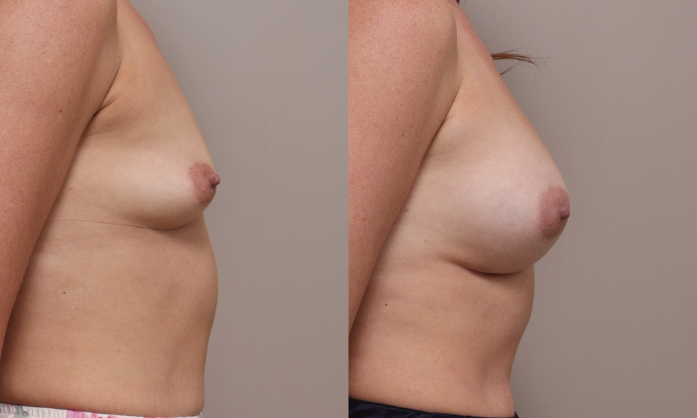 Breast Aug img 1 3 Gallery Breast Augmentation - 11