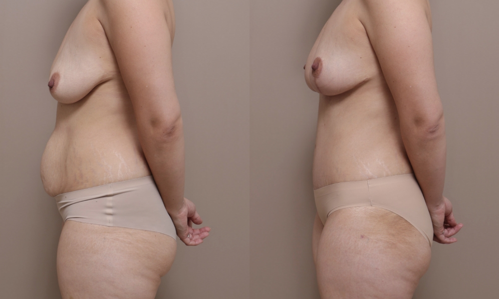 Breast Lift Abdo img 1 3 Gallery Abdominoplasty - 15