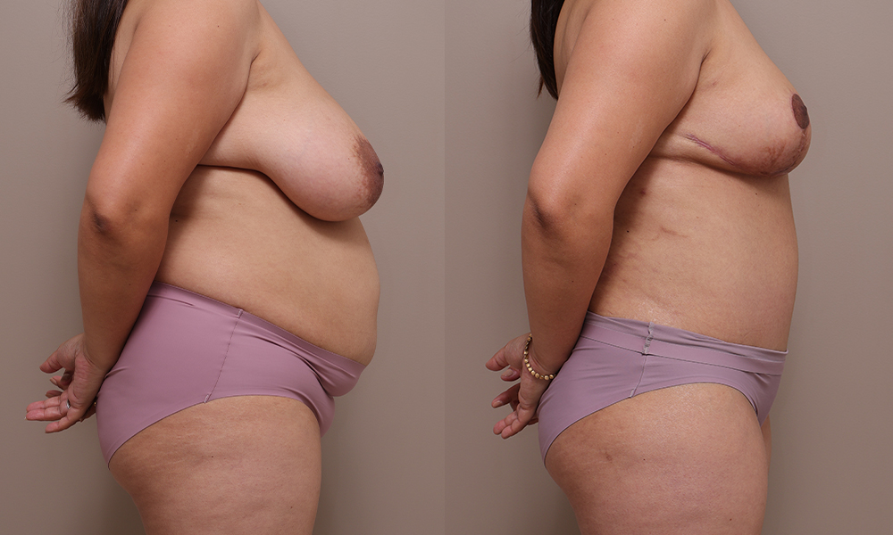 Breast Reduction Abdo img 1 3 Gallery Breast Reduction - 18