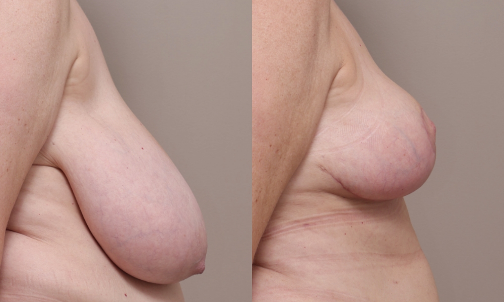 Breast Reduction Asymmetry img 1 3 Gallery Breast Reduction - 15